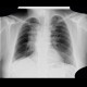 Lung tumour, postirradiation changes: X-ray - Plain radiograph